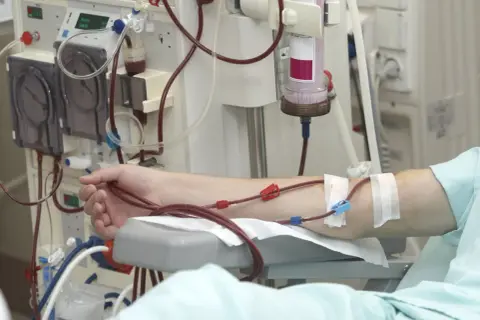 Ramię pacjenta podłączone do aparatury do dializy. Czerwone wężyki prowadzą krew do i z maszyny.