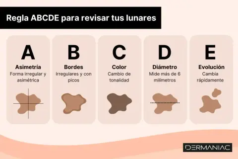 Regla ABCDE para revisar lunares: Asimetría, Bordes irregulares, Color cambiante, Diámetro mayor a 6mm, Evolución rápida. Una mancha negra en la piel puede ser señal de alerta.
