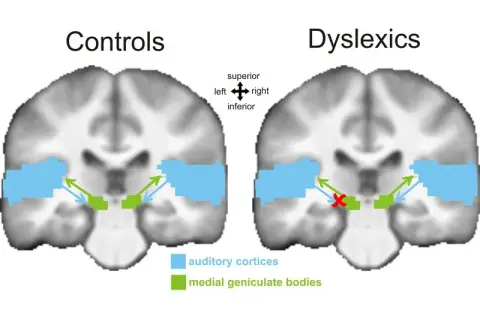 Czy dysleksja to choroba? Prawda o zaburzeniu neurorozwojowym