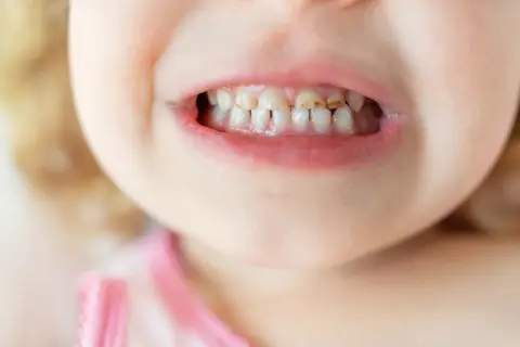Uśmiech dziecka, na którym widać mleczne zęby. Zastanawiasz się, ile zębów ma roczne dziecko? Zwykle od 4 do 8.