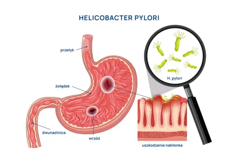 Helicobacter pylori uszkadza żołądek, powodując wrzody. Choć obraz skupia się na fizycznych objawach, warto pamiętać o potencjalnych helicobacter pylori objawy psychiczne, jak stres czy niepokój.