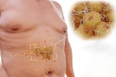 Addome con accumuli di grasso viscerale, ingrandimento di cellule adipose. Obiettivo: eliminare grasso viscerale.