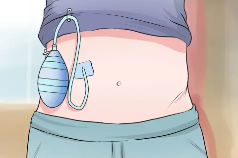 Un addome con un drenaggio chirurgico, una sacca blu a righe attaccata con un tubo. Questo dispositivo aiuta a rimuovere fluidi in eccesso, spiegando cos'è il drenaggio.