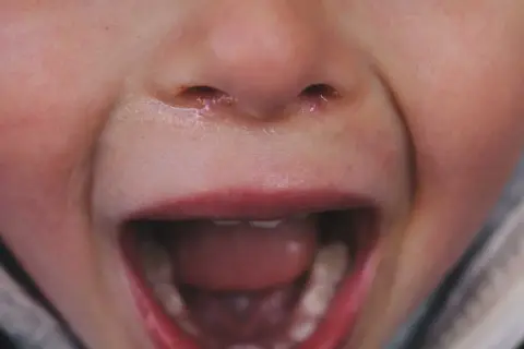 Bocca aperta di un bambino con denti storti da ciuccio, naso umido e labbra rosse.