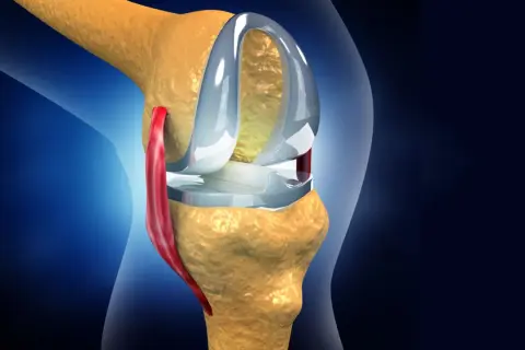 Knieprothese im Detail. Nach einer Meniskus-OP wie lange krank? Rehabilitation ist entscheidend.