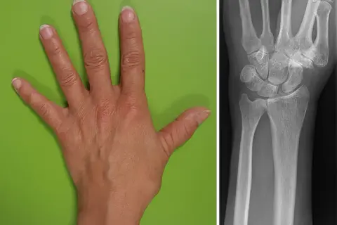 Hand und Röntgenbild des Handgelenks. Der **flexor carpi radialis** ist ein wichtiger Muskel für die Handbewegung.