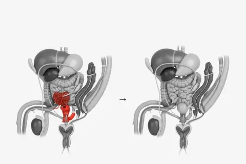 Anatomische Darstellung: Vorher (Prostata rot hervorgehoben) und nach der Prostataentfernung.