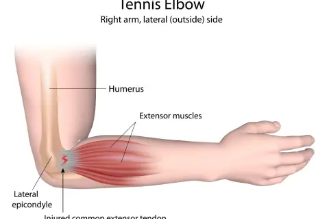 Illustration zeigt den rechten Arm bei Tennisarm. Schmerzen entstehen durch verletzte Sehnen am seitlichen Ellbogenknochen.