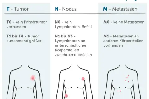 TNM-Klassifikation: Tumorgröße (T), Lymphknotenbefall (N) und Fernmetastasen (M) zur Beurteilung von malignen Tumoren.