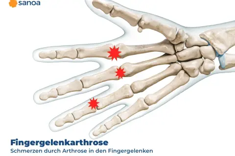 Illustration der Knochen der Hand, die Schmerzen durch Arthrose in den Fingergelenken zeigt.