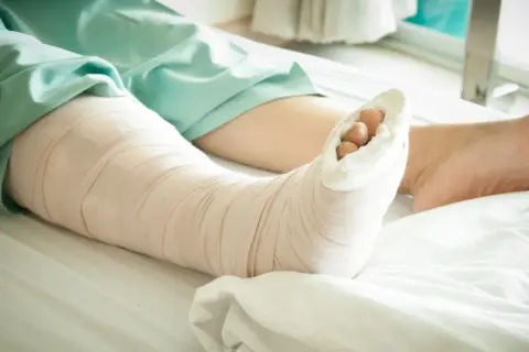 Noga w gipsie leży na szpitalnym łóżku. Palce stopy wystają z opatrunku, czekając na powrót do zdrowia.