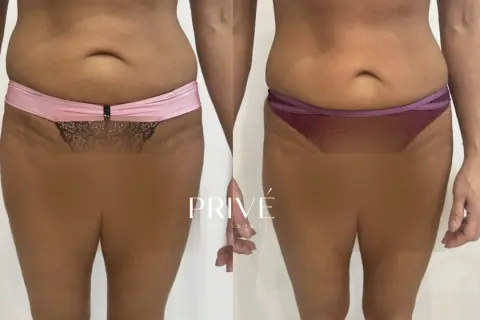 Endermologia: Bezinwazyjne modelowanie sylwetki co musisz wiedzieć?