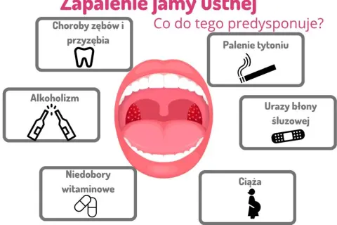 Ból w ustach? Zapalenie jamy ustnej objawy, rodzaje, pomoc