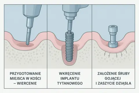 Wizualizacja etapy implantacji zęba: wiercenie, wkręcanie implantu tytanowego, założenie śruby gojącej. Czy implant zęba boli? Proces jest bezbolesny.