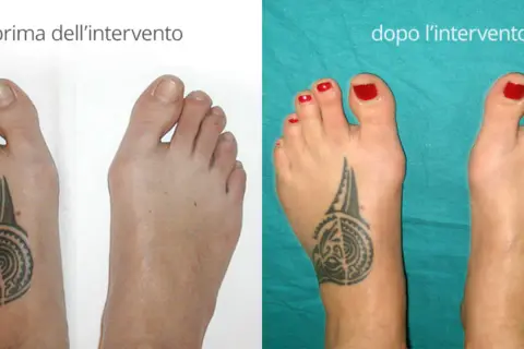 Confronto alluce valgo prima e dopo intervento. Il piede sinistro mostra un evidente alluce valgo, il destro è corretto.