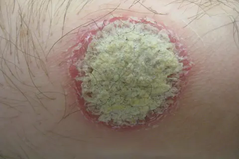 Gros plan d'une lésion cutanée circulaire sur la peau, avec une bordure rouge et une zone centrale squameuse et jaunâtre. Ce petit bouton sur le ventre qui ne gratte pas semble être une mycose.