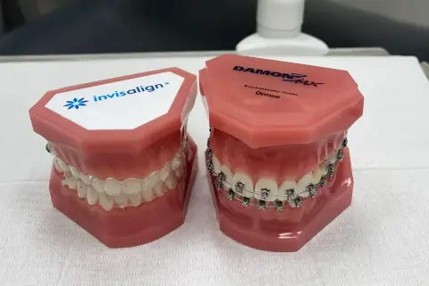 Modele szczęk pokazujące Invisalign i tradycyjny aparat na wadę zgryzu.