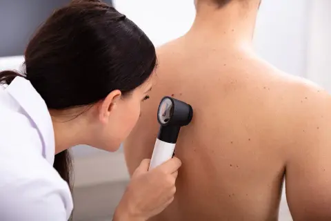 Ärztin untersucht Muttermale am Rücken eines Patienten. Hautkrebs ist nicht ansteckend.