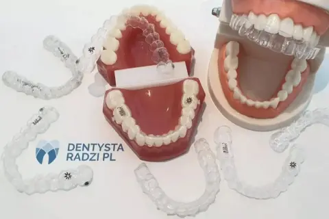 Modele szczęk pokazują, jak zakładać gumki na aparat ortodontyczny. Przezroczyste nakładki są ułożone wokół modeli.