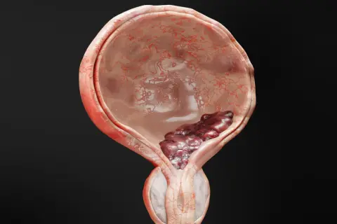 Darstellung einer Blase mit einem dunklen, unregelmäßigen Tumor, der auf muskelinvasiven Blasenkrebs hindeutet.