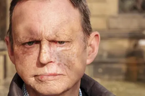 Ein Mann mit Narben im Gesicht, der die Hilfe eines Onkologen benötigt.