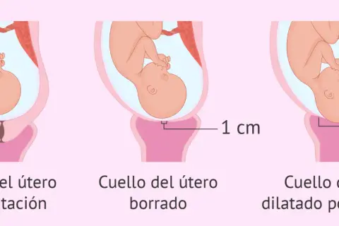 Ilustración muestra la dilatación del cuello uterino durante el parto: sin dilatación, borrado y dilatado por completo (10 cm).