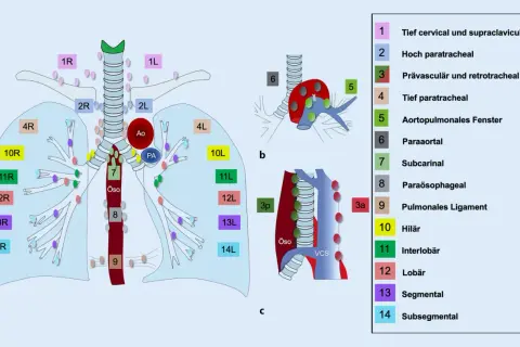 Schema der Lymphknotenstationen im Thorax. Station 10 zeigt die **hilus lymphknoten** im Lungenhilus.