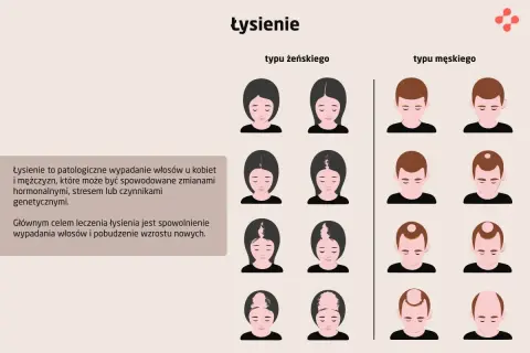 Ilustracja pokazuje różne rodzaje łysienia u kobiet i mężczyzn, od początkowych etapów po zaawansowane.