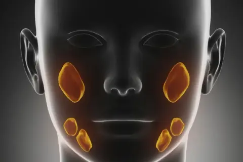 Anatomia ślinianek z widocznymi ogniskami kamicy. Złote plamy symbolizują kamienie w śliniankach.