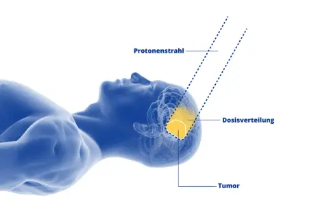 Protonenstrahltherapie zur Behandlung eines Hirntumors. Die Dosisverteilung zeigt, wie der Protonenstrahl den Tumor präzise trifft. Dies kann die Lebenserwartung bei Sarkomen verbessern.