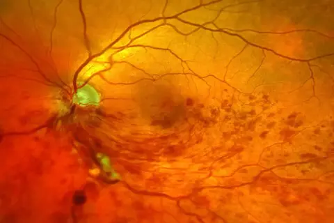 Nahaufnahme des Augenhintergrunds mit Anzeichen eines Schlaganfalls im Auge. Blutgefäße sind sichtbar, einige Bereiche sind verfärbt.