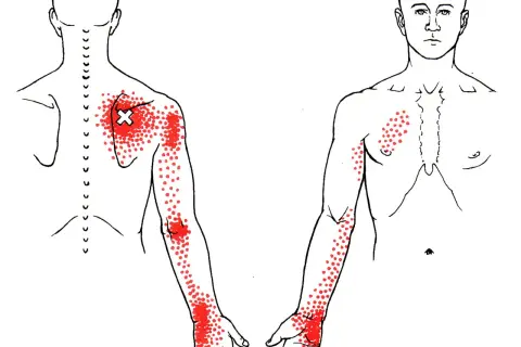 Dolor serrato posterior superior: Alivio y prevención efectiva