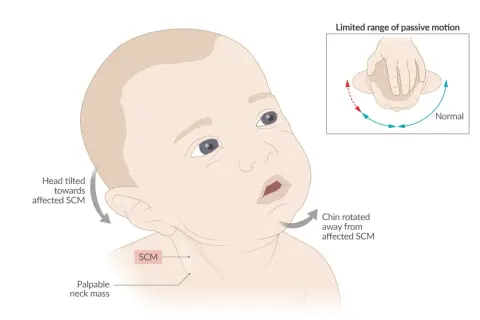 Baby mit angeborenem Schiefhals (torticollis spasticus). Kopf zur betroffenen SCM geneigt, Kinn weggedreht. Eingeschränkte Beweglichkeit.