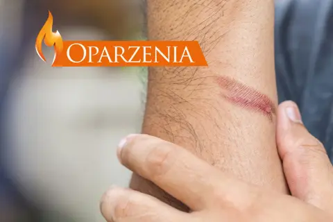 Oparzenia na przedramieniu. Zobacz, co na oparzenia pomoże.