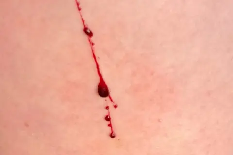 Rote Kratzer auf der Haut ohne Grund, mit Blutstropfen, die langsam herunterlaufen.