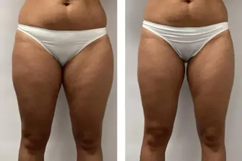 Endermologia: Kiedy efekty? Po 3 sesjach już widać! Pełna przemiana