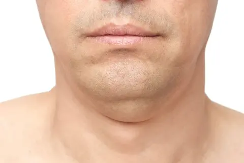 Primer plano de la barbilla y el cuello de un hombre, mostrando papada. Una imagen que ilustra cómo adelgazar la cara.