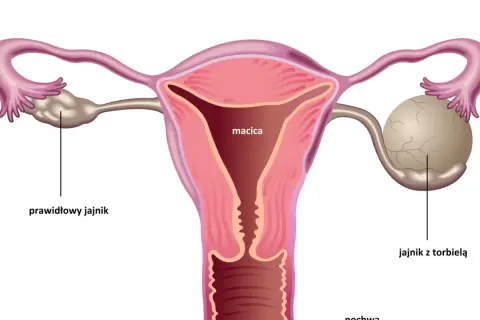 Anatomical illustration showing a uterus, fallopian tubes, and ovaries. One ovary is normal, the other has a cyst. This visual helps understand torbiel na jajniku objawy.
