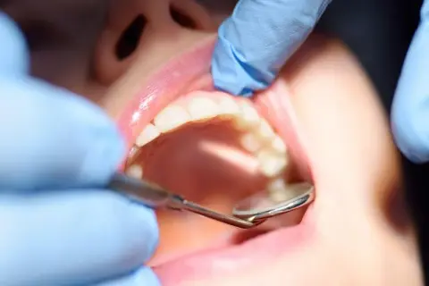 Dentysta bada zęby, szukając oznak próchnicy wtórnej.