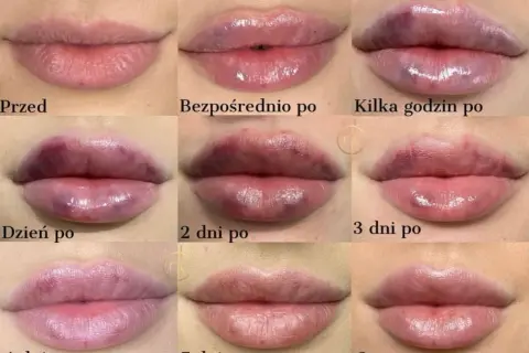 Kwas hialuronowy w ustach: Ile się utrzymuje i jak przedłużyć efekt?