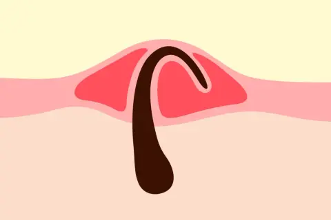 Illustration d'un poil incarné sous la peau, avec une partie sombre courbée sous une couche rouge.