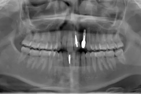 Radiografia panoramica dentale che mostra la sinfisi mandibolare con impianti dentali nella mascella e nella mandibola.