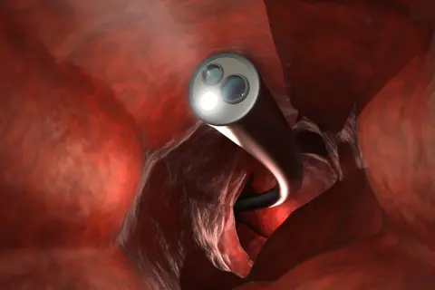 Endoskop leuchtet den Darm aus. Eine darmspiegelung neue methode ist weniger unangenehm dank moderner Technik.