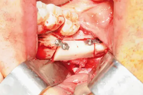Chirurgia orale: frammento osseo fissato con placche metalliche, vicino al nervo alveolare.