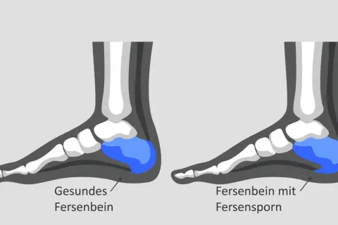 Vergleich von gesundem Fersenbein und Fersenbein mit oberem Fersensporn. Der Fersensporn ist als knöcherner Auswuchs am Fersenbein dargestellt.