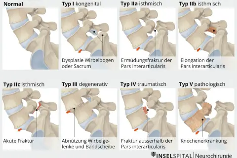 Abbildungen zeigen verschiedene Typen von Gleitwirbel LWS, von normal bis zu Frakturen und Erkrankungen.