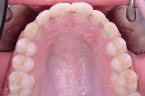 Filo contenzione denti: un sottile filo metallico applicato dietro gli incisivi per mantenere l'allineamento. Il costo varia.