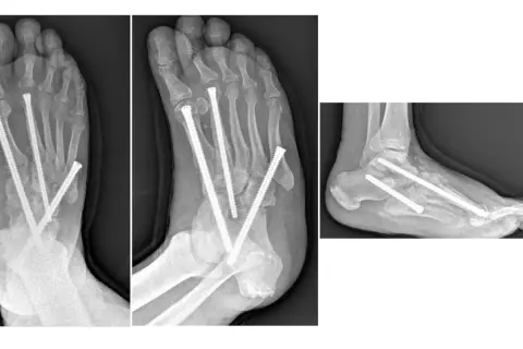 Radiografie di un piede Charcot con viti metalliche che stabilizzano le ossa fratturate.