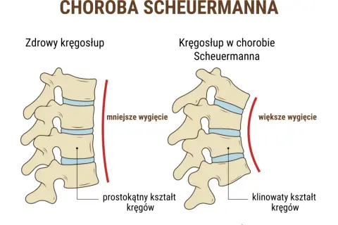 Ilustracja porównująca zdrowy kręgosłup z kręgosłupem w chorobie Scheuermanna.