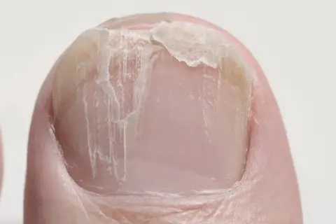 Nahaufnahme eines Zehennagels mit querrillen und abgebrochenen Stellen.